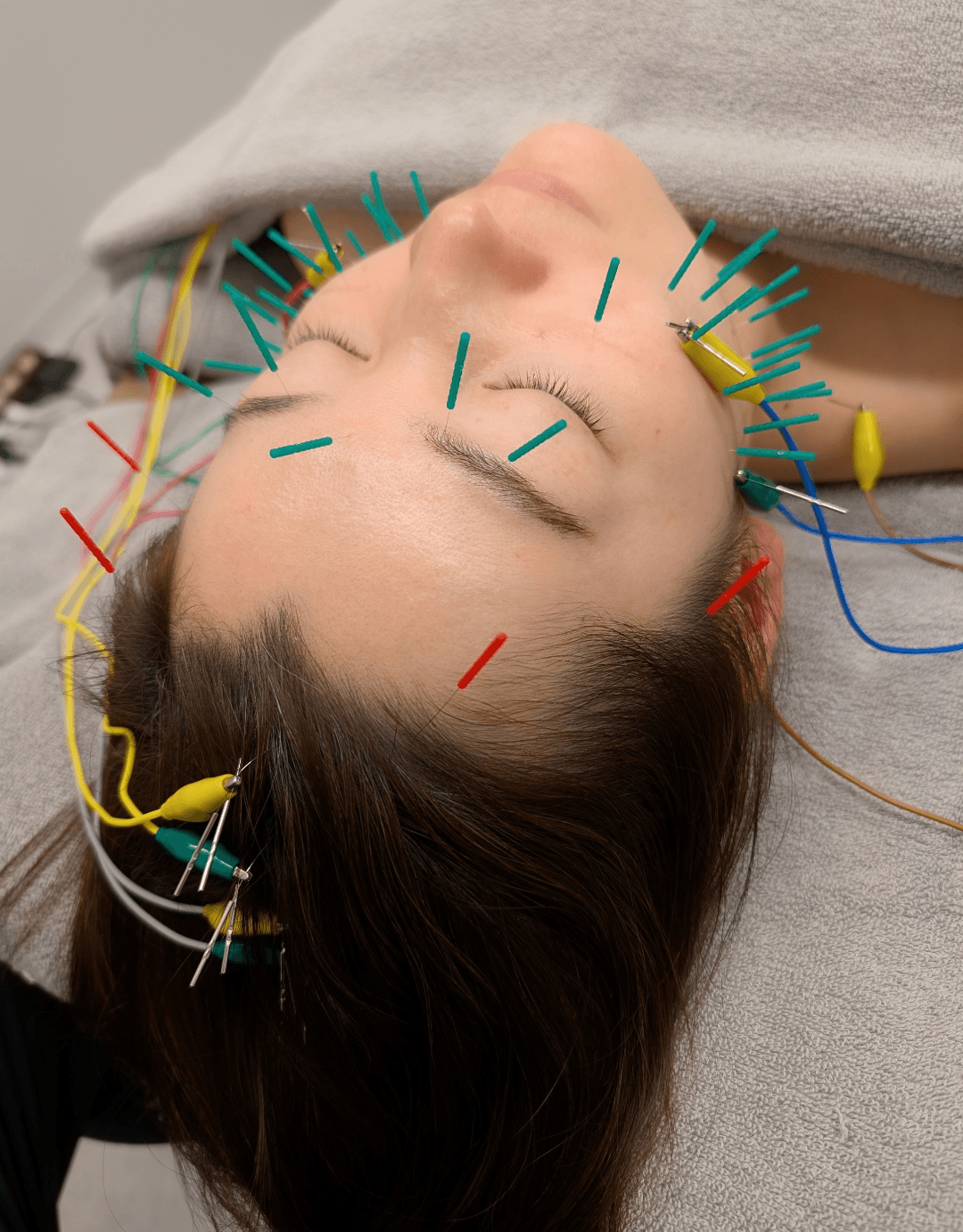 美容鍼の施術風景（顔・頭部への鍼灸）