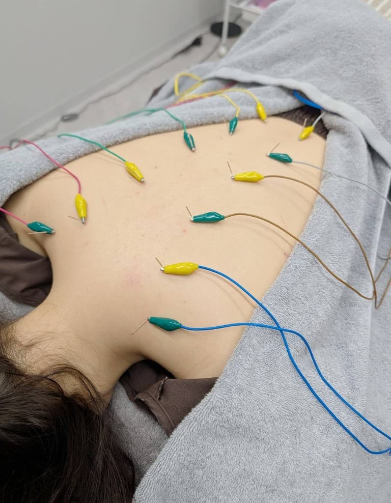 電気鍼の施術風景（背部・肩への鍼灸）